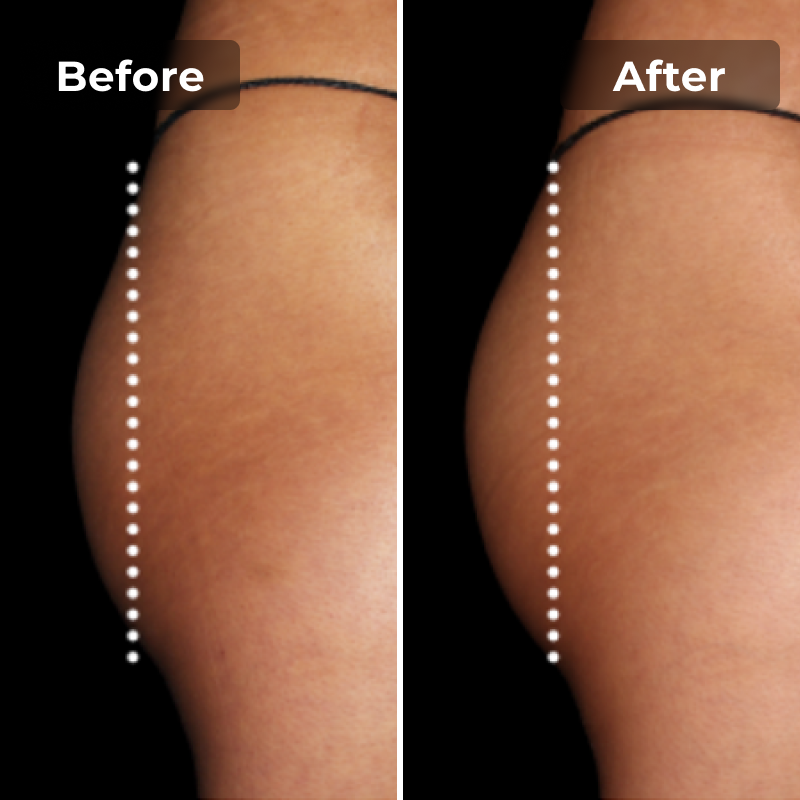 Megelin EMS Toning Shorts