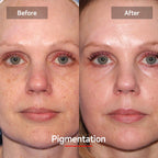 LASER&LED LIGHT Therapy Mask