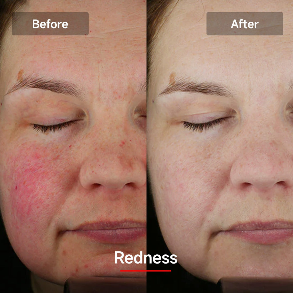 LASER&LED LIGHT Therapy Mask