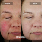 LASER&LED LIGHT Therapy Mask