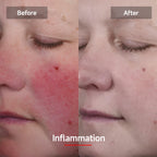 LASER&LED LIGHT Therapy Mask